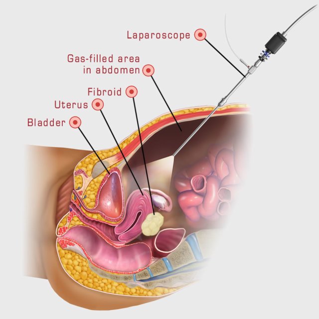 Myomectomy