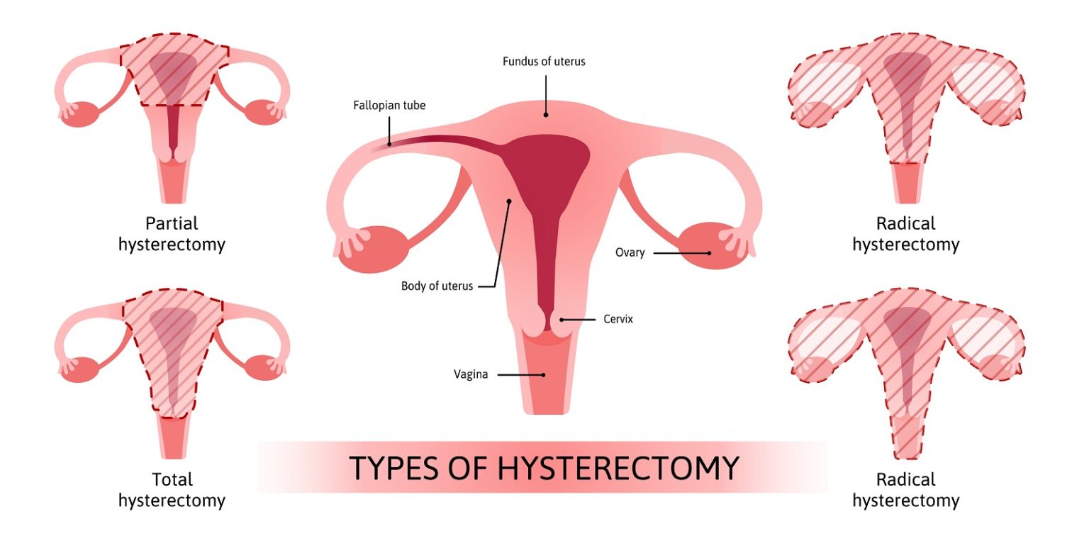 Should I Get a Hysterectomy for Fibroid Removal? Fibroid Institute Texas