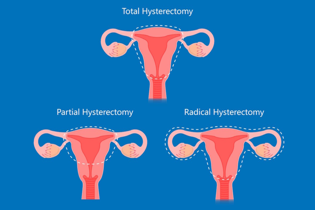 fibroid removal hysterectomy