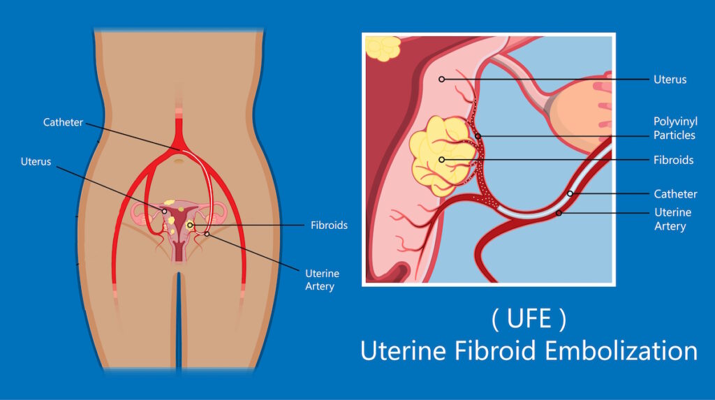 not fibroid removal illustration ufe fibroid tumor treatment 